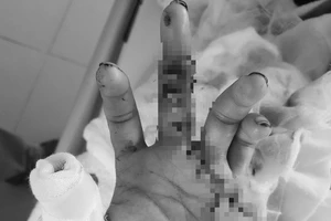 Nối thành công 2 ngón tay đứt lìa cho nam thanh niên 33 tuổi