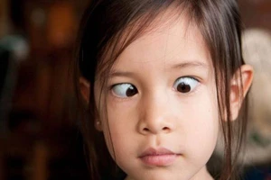 Trẻ bị lé đột ngột có cần đi khám không bác sĩ?