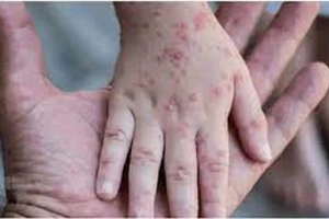 Có các triệu chứng này nên nghĩ đến bệnh đậu mùa khỉ