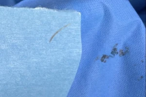 Hóc xương cá, người phụ nữ bị nhiễm trùng huyết suýt tử vong