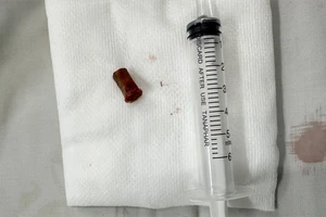 Ho kéo dài vì chiếc kèn bị bỏ quên trong phổi 7 năm