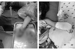 Lượm pháo nhà hàng xóm chơi, bé gái 5 tuổi bị mất một bàn tay