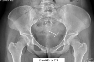 Có 2 vòng tránh thai trong bụng nhiều năm mà không biết