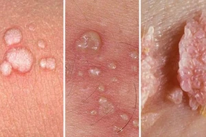 Bị sùi mào gà có vô sinh không?