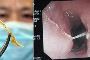 Hóc dị vật, tưởng bình thường mà nguy hiểm khôn lường