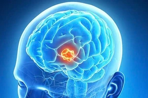 Bệnh ung thư não diễn viên Quý Bình mắc phải nguy hiểm ra sao?