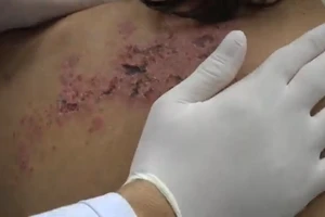 Bị zona thần kinh, ba tôi đòi đưa đến thầy lang vẽ 'bùa khoán'