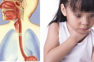 Bé trai 5 tuổi suýt thủng thực quản vì hóc xương cá ba sa