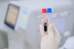 Nam thanh niên có huyết thanh đục trắng như sữa hiếm gặp