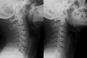 Đau cổ vai gáy kéo dài, đi khám phát hiện hội chứng cổ thẳng nguy hiểm