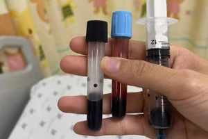 Máu bé gái chuyển đen do ngộ độc methemoglobin sau bữa ăn