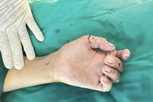 Bé trai suýt mất 2 ngón tay do nghịch dao cắt cỏ