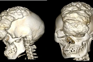 Khối u khổng lồ làm biến dạng khuôn mặt cô gái suốt 15 năm