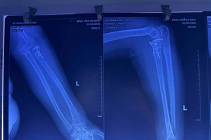 Phối hợp chuyên khoa sâu cứu bệnh nhân gãy xương khỏi 'tam chứng đau khổ'