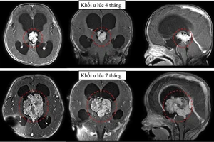 Đầu to dần sau sinh, bé trai 7 tháng tuổi phát hiện mắc u não khổng lồ hiếm gặp