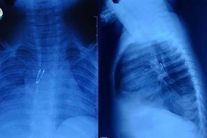 Bóng đèn LED mắc kẹt trong phế quản bé gái 9 tháng tuổi