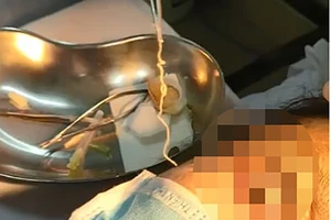 Con giun sán dài 10 cm sống trong mắt 1 phụ nữ