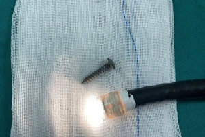 Bé 34 tháng tuổi nuốt đinh vít vào bụng