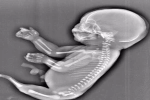 Người mẹ Trung Quốc phá thai vì con là 'người cá'