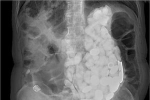 Ăn đá sỏi, nắp chai và tiền xu vì lo âu