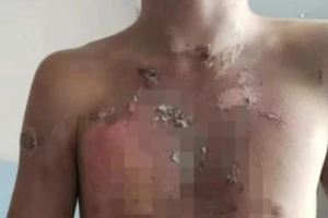 Năm nam sinh được cho là bị bóp cổ liên tục cho đến khi họ bất tỉnh sau đó lại bị dội nước sôi vào người.