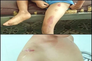 Sóc Trăng: Bé trai 6 tuổi bị cha dượng bạo hành
