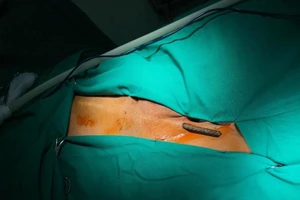 Nhảy từ trên xe xuống đất, bị thanh sắt dài xuyên thấu đùi 