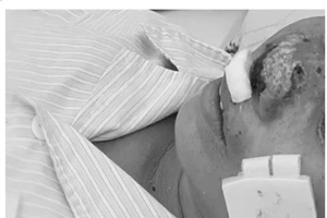 Bộ Y tế hướng dẫn cách phòng ngừa bệnh whitmore