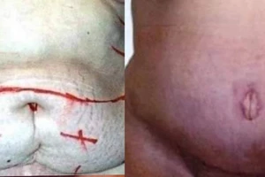 Gần 4 tiếng hút mỡ ra khỏi người phụ nữ bị 'béo phì'