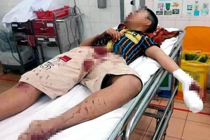Dùng bột diêm để chế pháo, thiếu niên bị thương