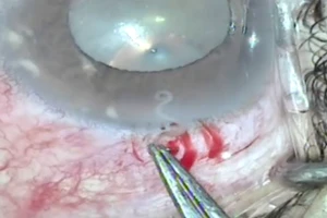 Kỳ lạ: Con giun đũa chó sống trong mắt người phụ nữ