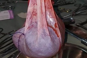 Cụ bà 102 tuổi mang khối u nặng 6 kg nhiều năm