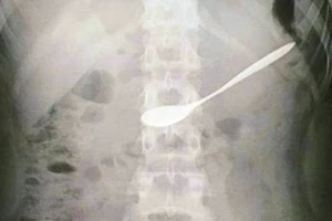 Cứu cô gái 20 tuổi đi uống cà phê nuốt chiếc thìa vào bụng 