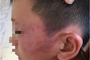 Cô giáo "lỡ tát" con của chồng bầm tím phải nhập viện