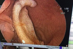 Nội soi lấy phần tai bị cắt đứt trong bụng một học sinh