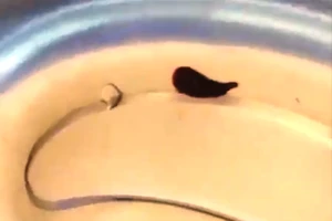 Gắp con vắt dài 5cm sống trong mũi một phụ nữ