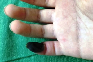 Hoại tử ngón tay sau khi bôi thuốc trị mụn cóc mua trên mạng
