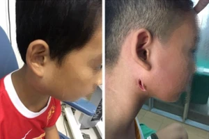 Đã điều trị thành công cho một trẻ em bị bệnh Whitmore