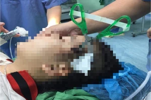 1 học sinh 10 tuổi bị cây kéo găm vào vùng đầu
