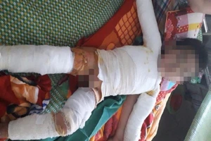 Cứu trẻ 5 tuổi bị bỏng nặng do nghịch bật lửa gas 