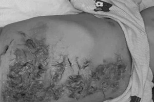 Nghệ An: Thầy lang đắp lông động vật lên mình bé 8 tháng tuổi để chữa bỏng