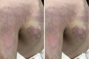 1 học sinh lớp 3 bị bầm vai nghi do cô giáo đánh