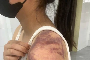 Minh dùng tay, chân, chổi quét nhà tấn công gây thương tích con là cháu T.