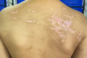 Khởi tố người cha đánh con gây 21 vết sẹo