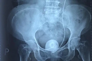 Quên ống thông 9 năm trong cơ thể, sỏi bám to bằng quả trứng