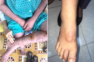 Coi chừng nhầm lẫn bệnh phong với viêm da