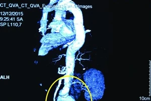 Bệnh nhân có mạch máu bụng phình to như trái bưởi