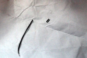 Dị vật 'chạy trốn', bác sĩ phải mổ ba lần mới lấy ra được