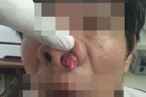 Lấy khối u 'thập thò' trong mũi bệnh nhân ​