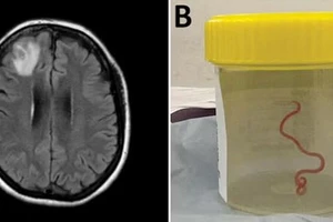 Phẫu thuật bắt ra giun còn sống trong não người, ca đầu tiên thế giới